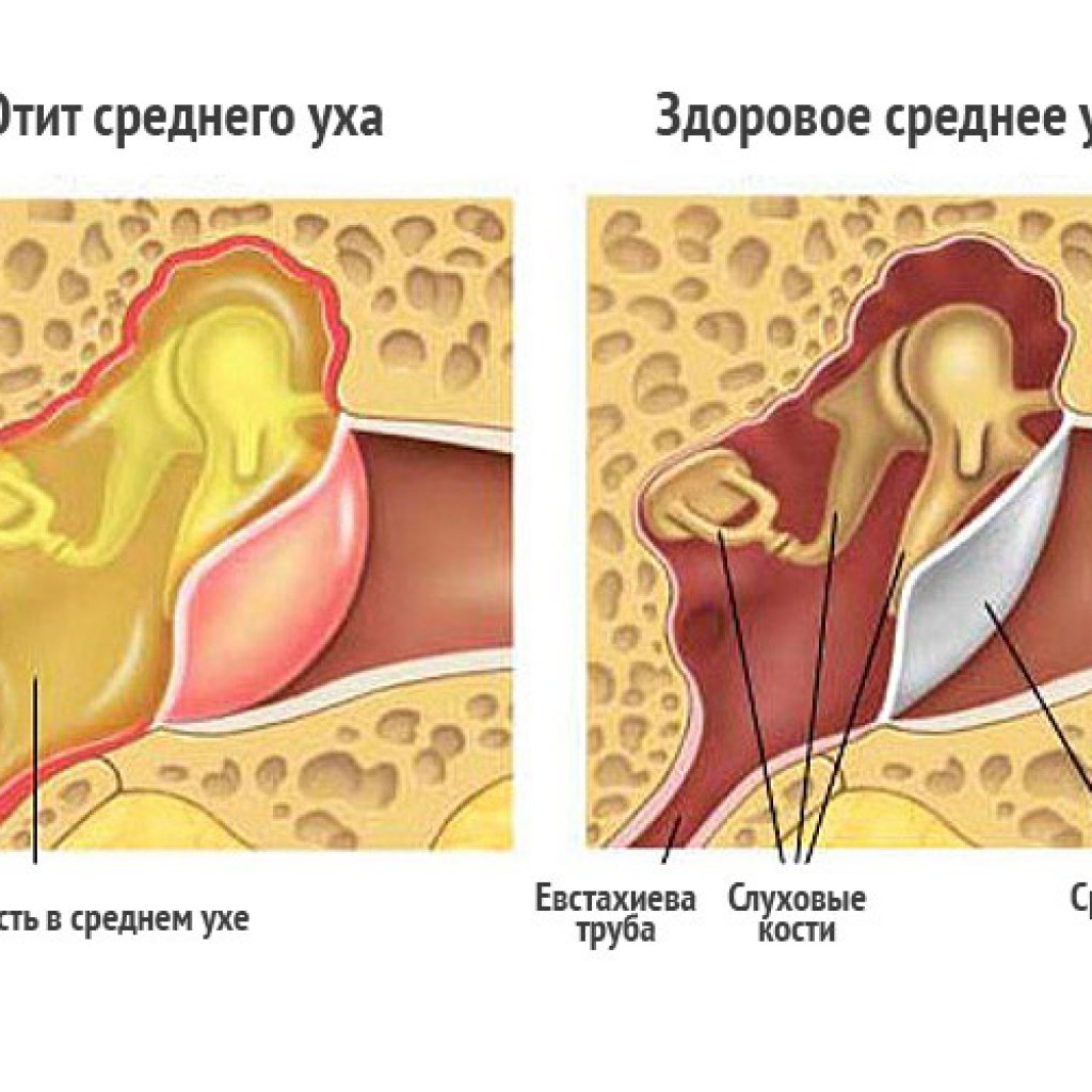 Лечение отита в домашних условиях 5 эффективных средств 4 Лечение отита в домашних условиях 5 эффективных средств 59