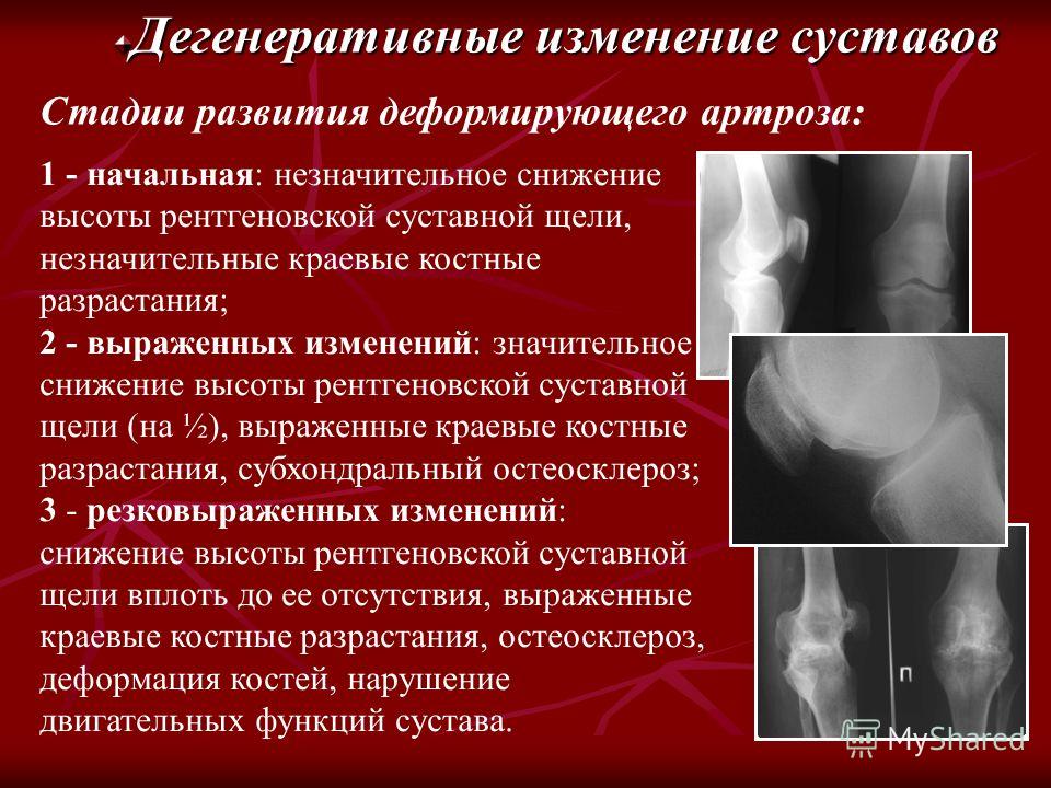 Первый деформирующий артроз Первый деформирующий артроз