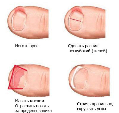 Все ногти на ногах отошли от кожи Все ногти на ногах отошли от кожи