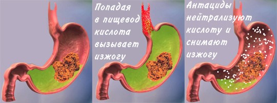 Что пить от изжоги в домашних условиях Что пить от изжоги в домашних условиях