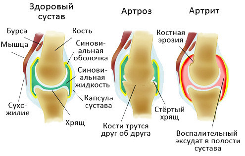 Стандарты лечения артроза коленного сустава Стандарты лечения артроза коленного сустава