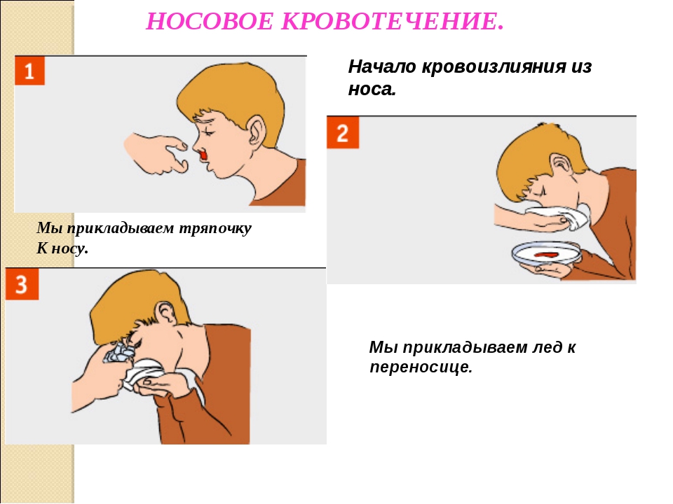 Как остановить кровотечение из носа в домашних условиях