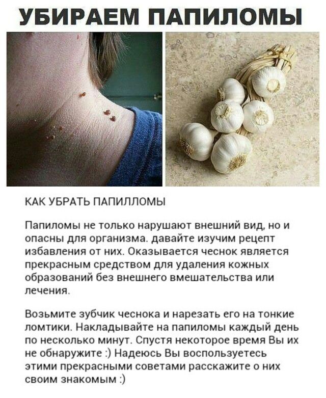 Вывести бородавки народный заговор Вывести бородавки народный заговор