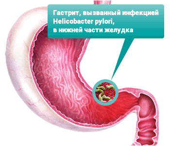 Как лечить народной медицины эрозивный гастрит Как лечить народной медицины эрозивный гастрит