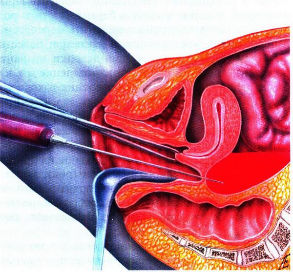 Операция конус в гинекологии