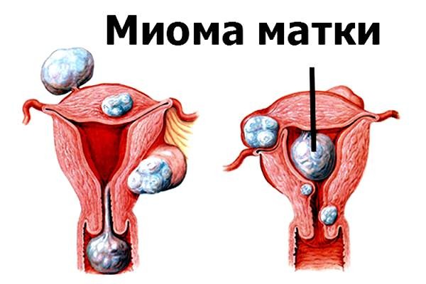 Корень бадана в гинекологии миома матки