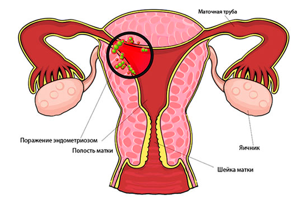 История болезни по гинекологии аденомиоз матки