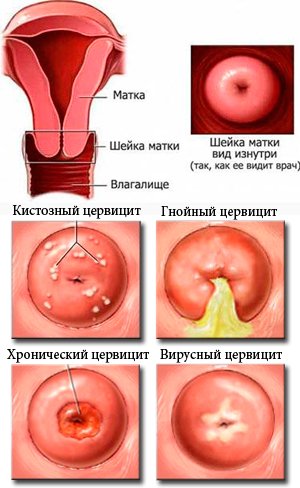 Гинекология воспаление слизистой оболочки